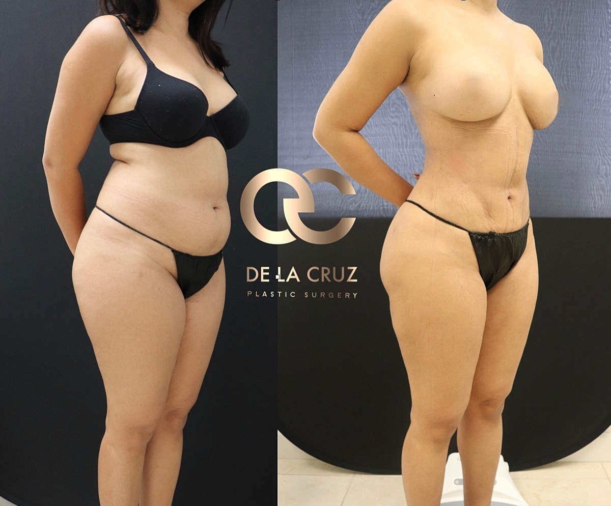 4d Vaser Liposuction Before & After
