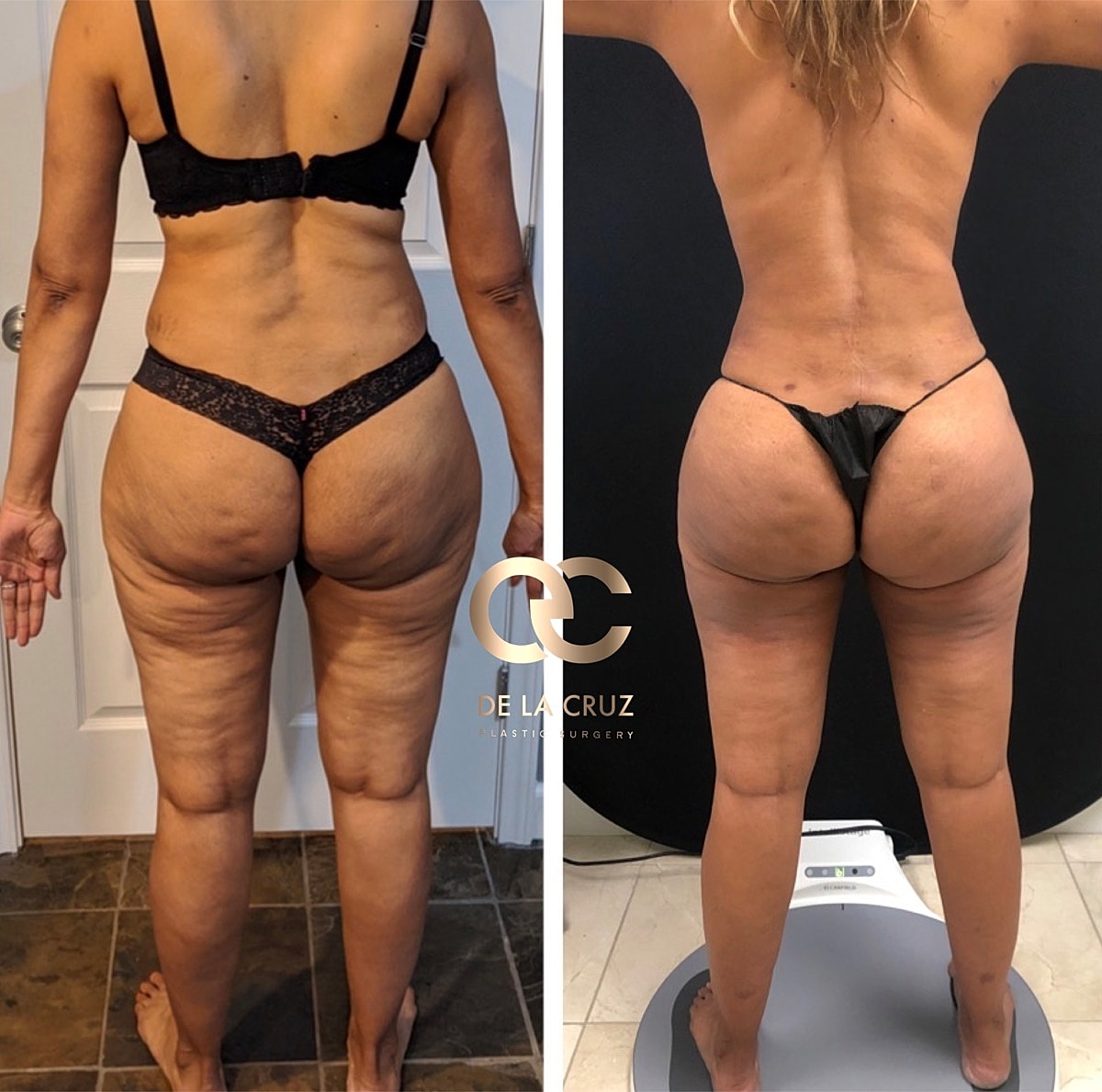 4d Vaser Liposuction Before & After