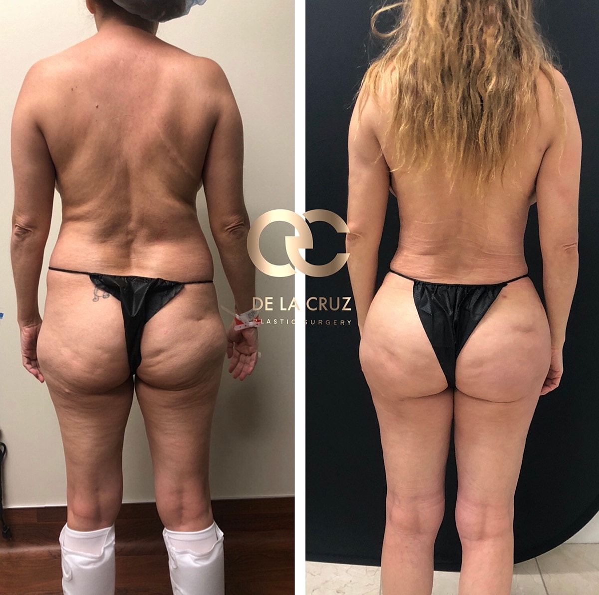 4d Vaser Liposuction Before & After