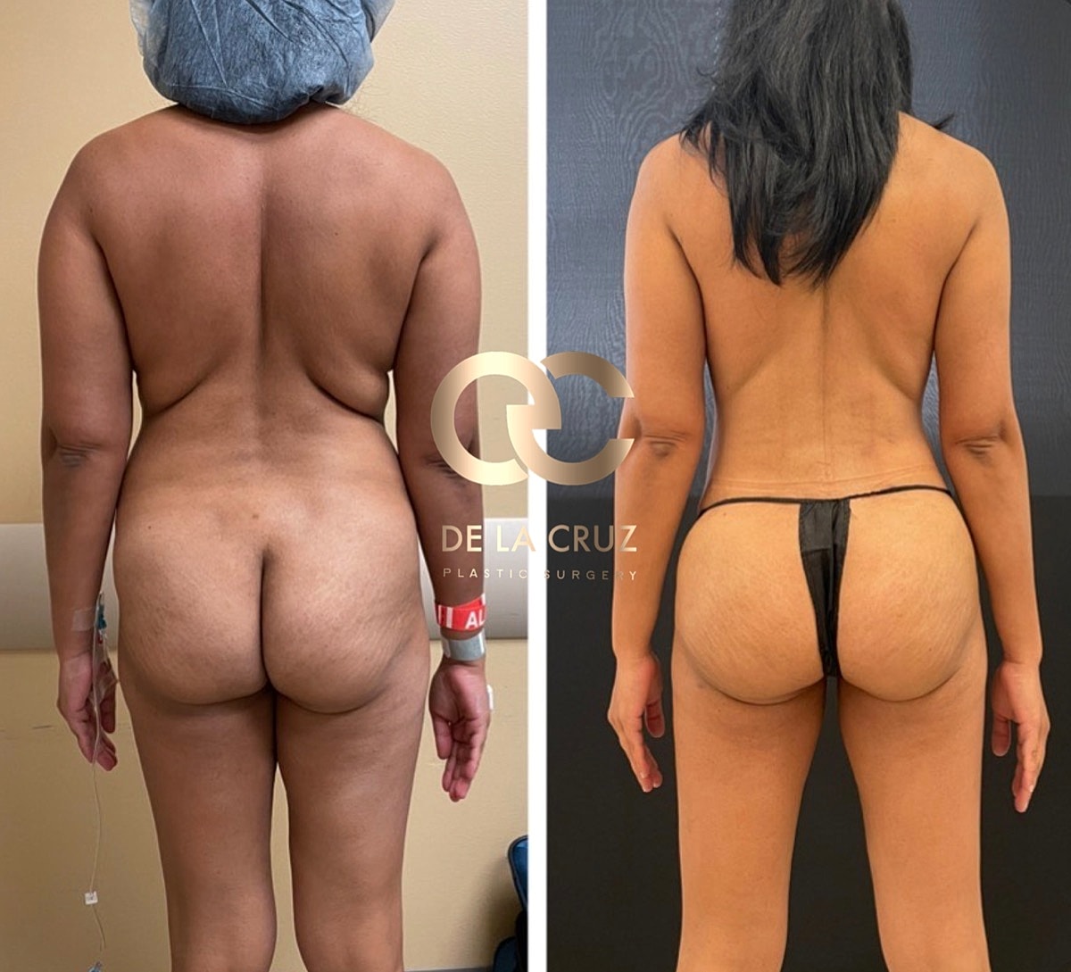 4d Vaser Liposuction Before & After