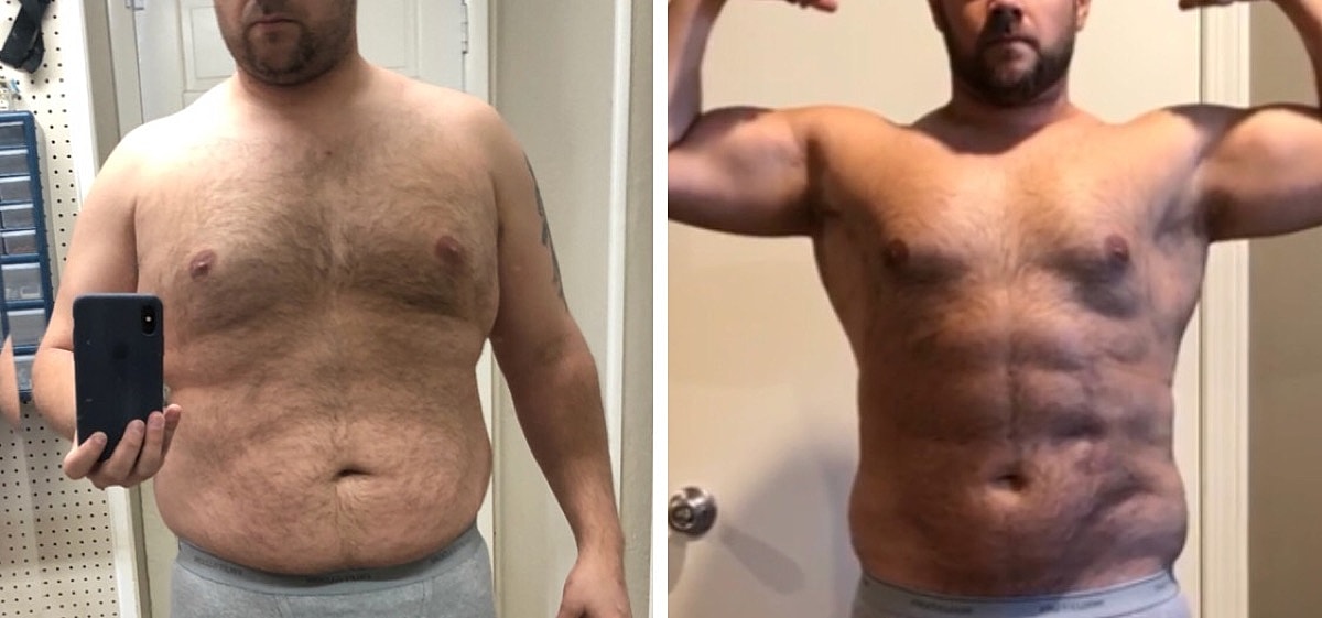 4d Vaser Liposuction Before & After