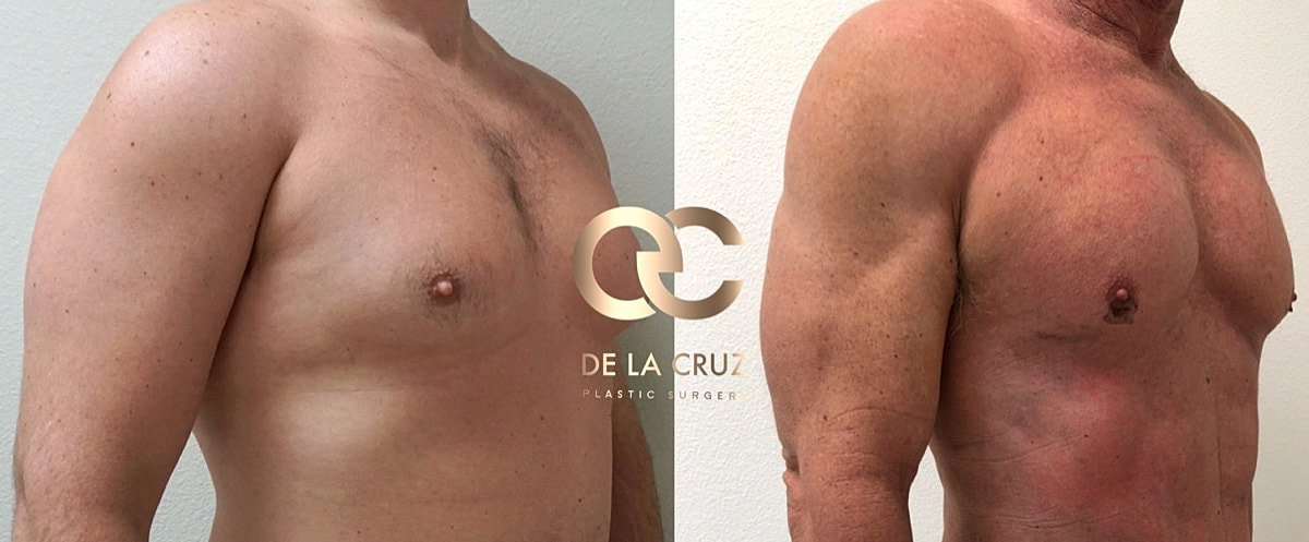 4d Vaser Liposuction Before & After