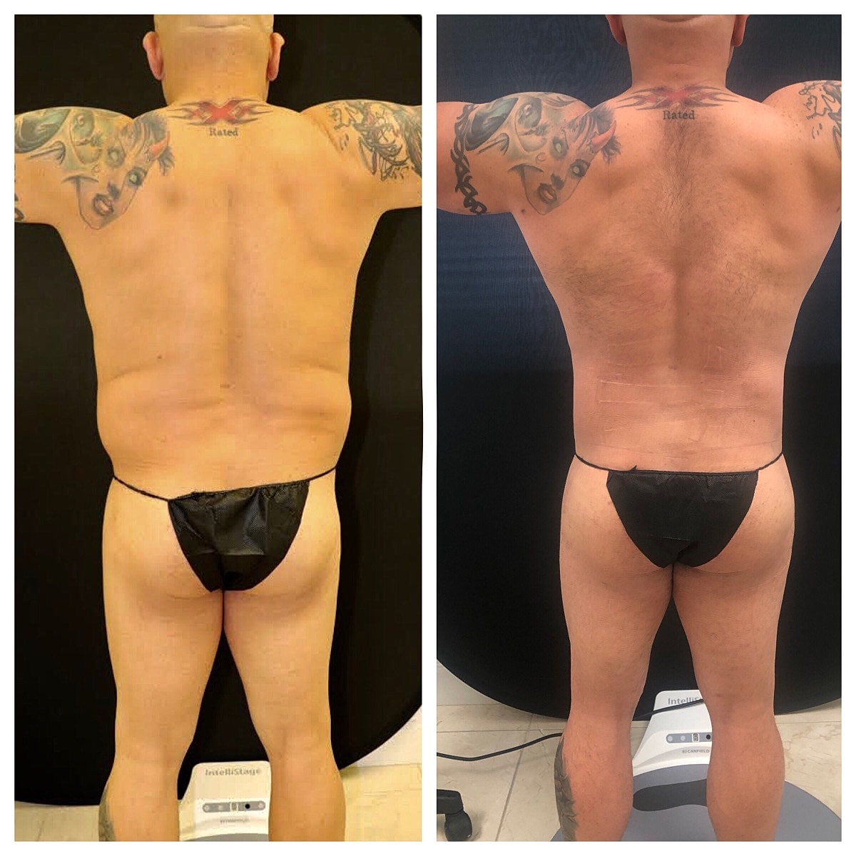 4d Vaser Liposuction Before & After