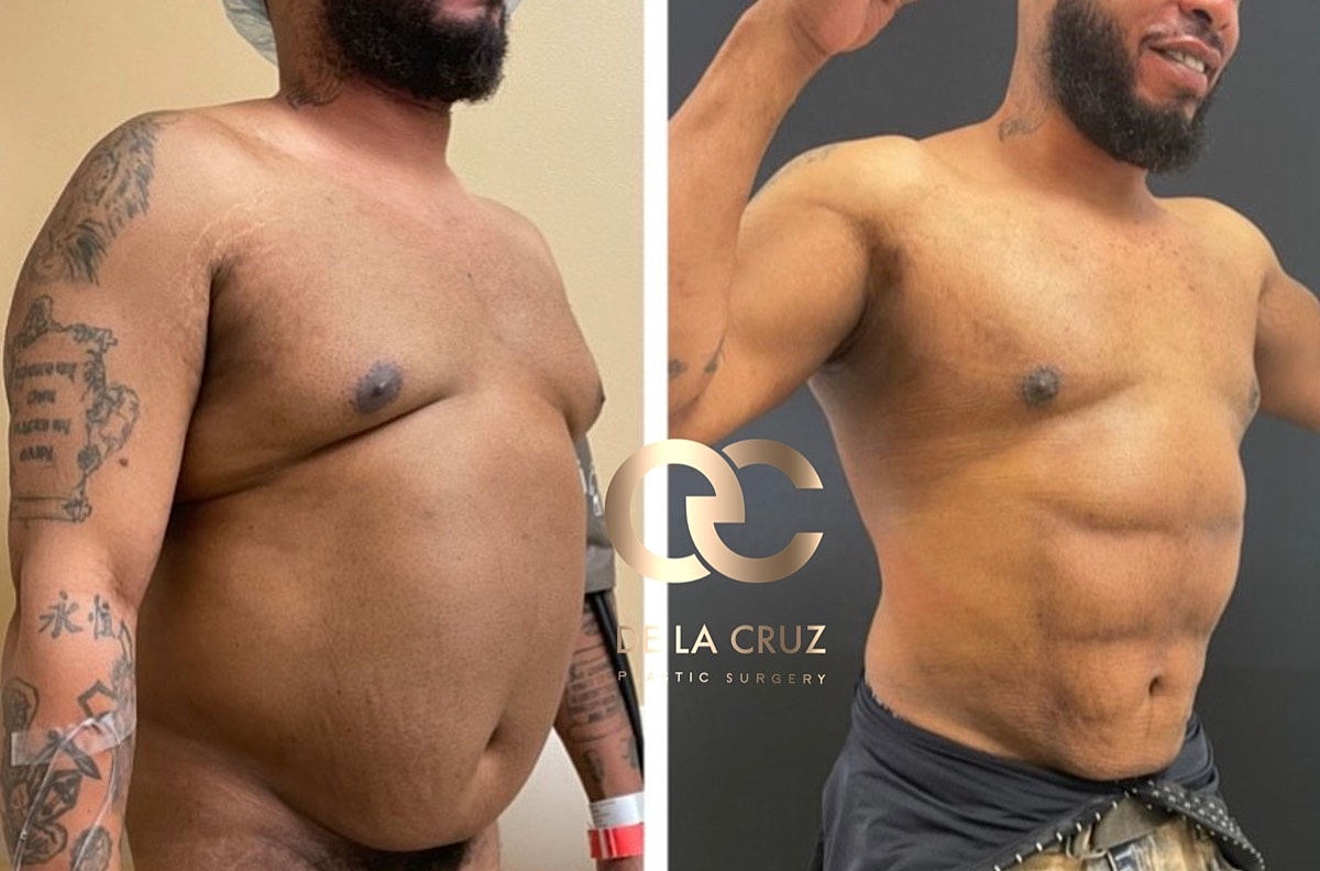 4d Vaser Liposuction Before & After