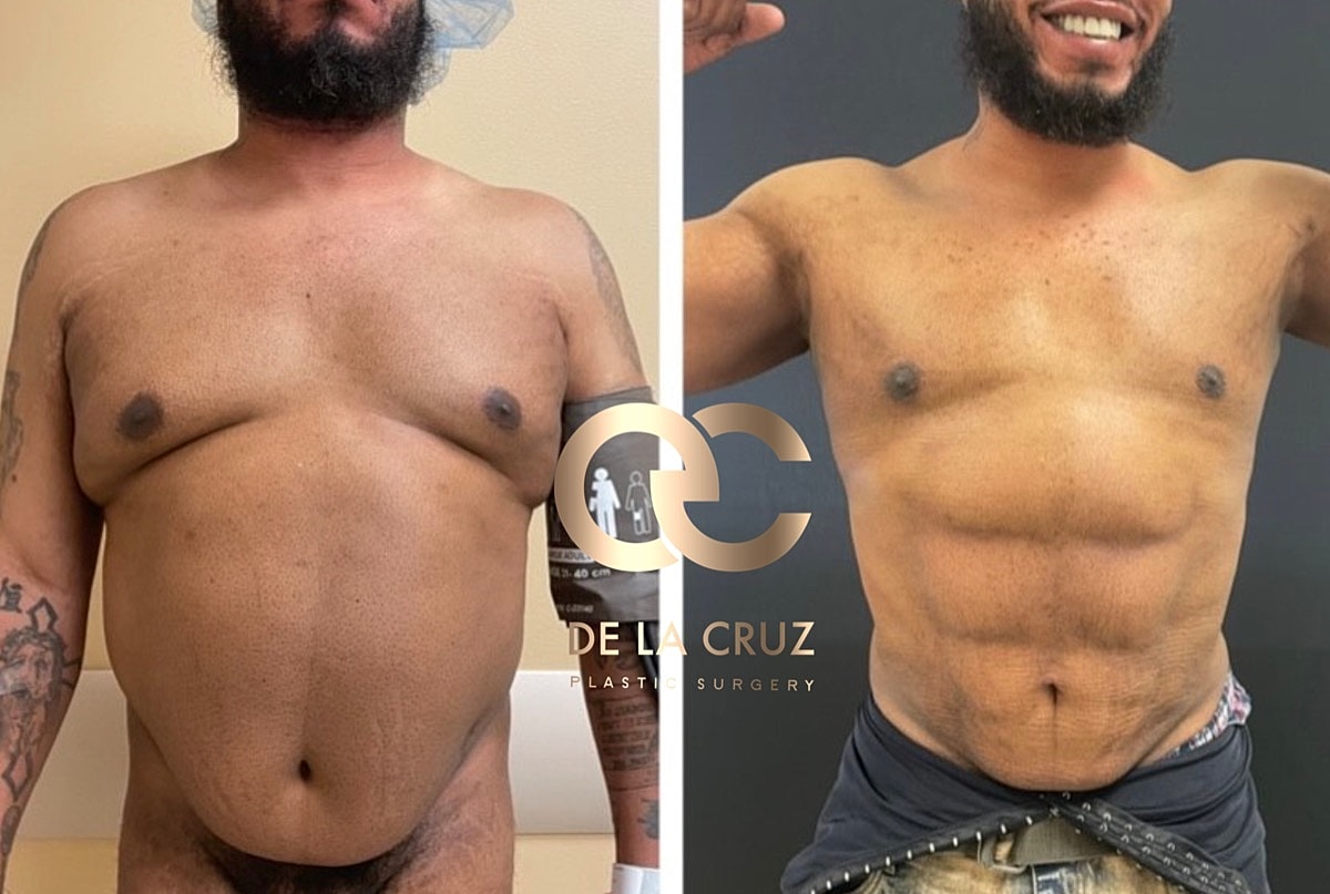 4d Vaser Liposuction Before & After