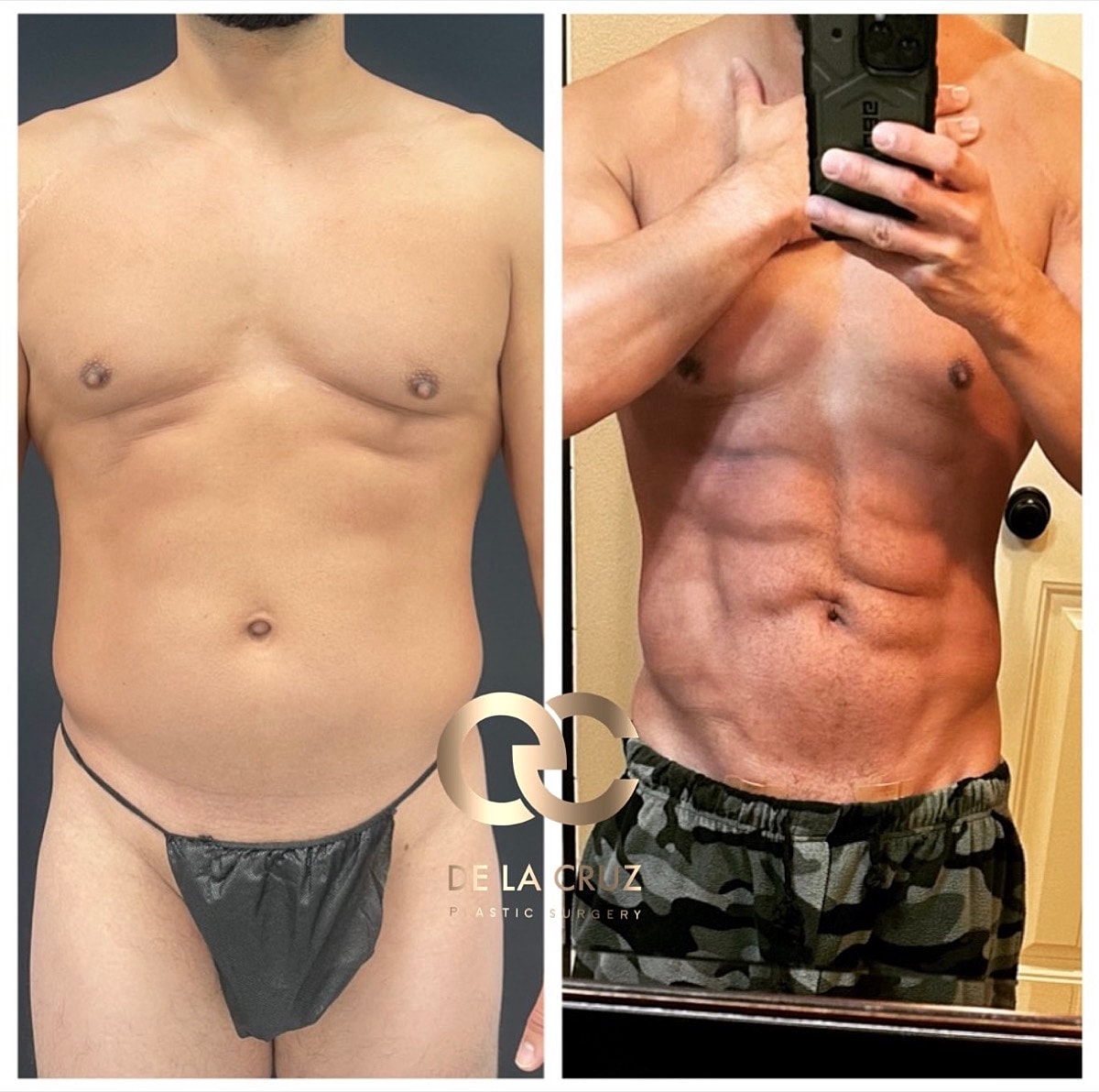 4d Vaser Liposuction Before & After