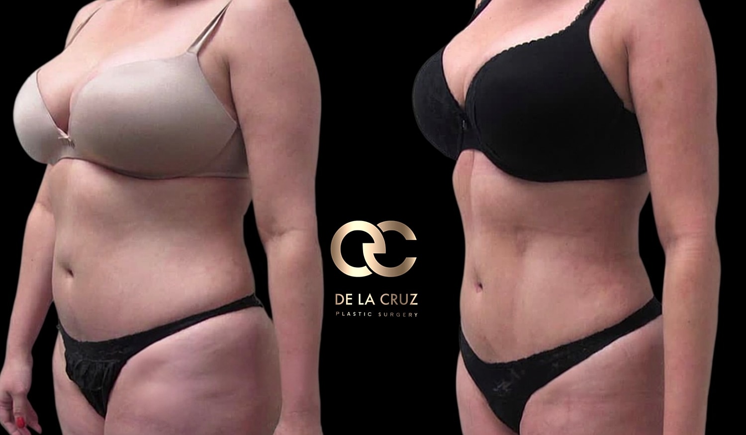 Before and after plastic surgery comparison image.