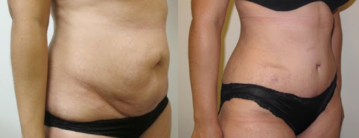 Abdominoplasty Before & After