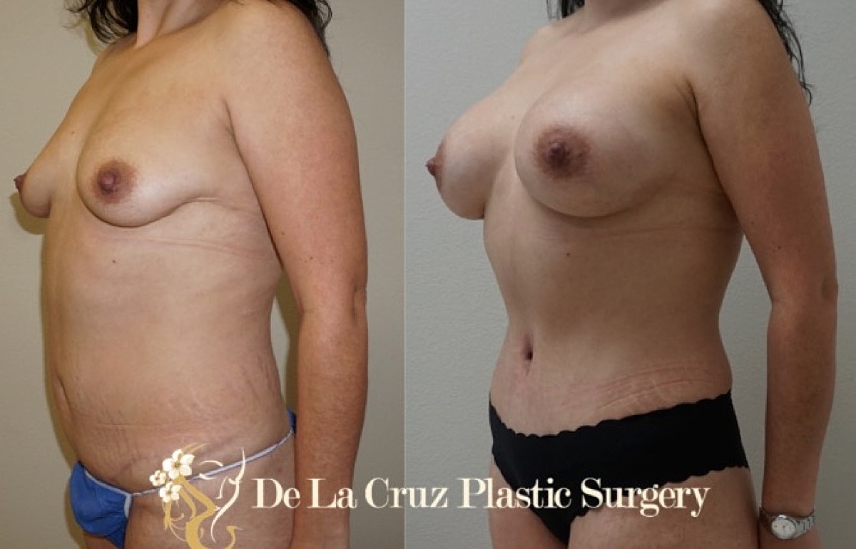 Abdominoplasty Before & After