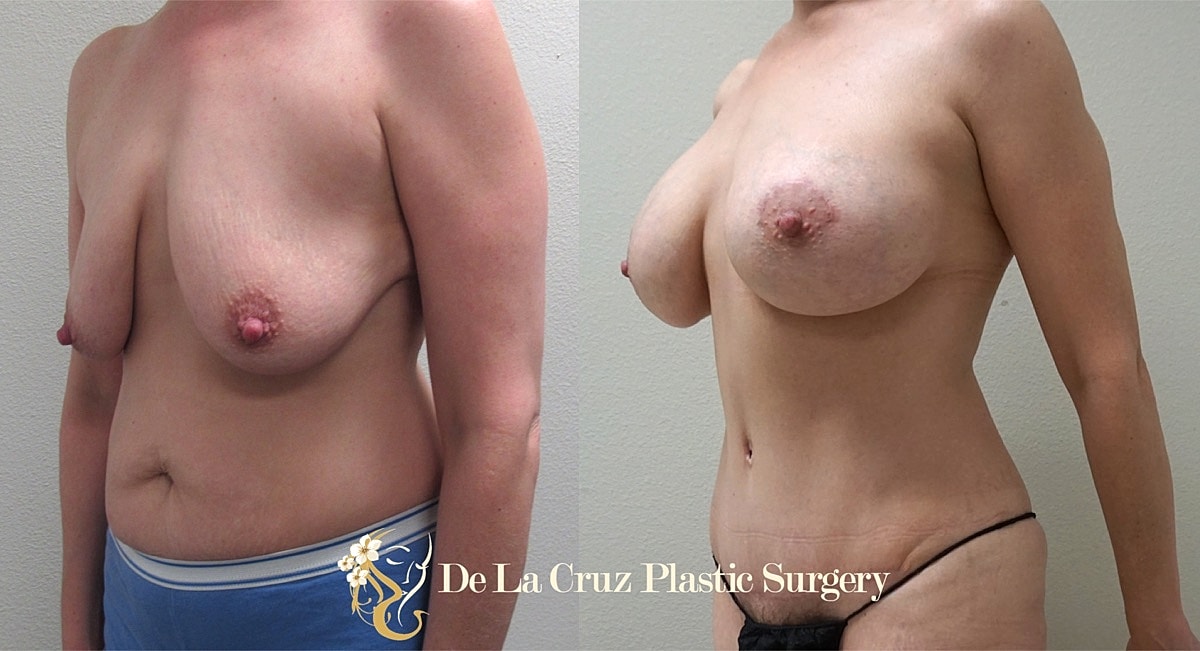 Abdominoplasty Before & After