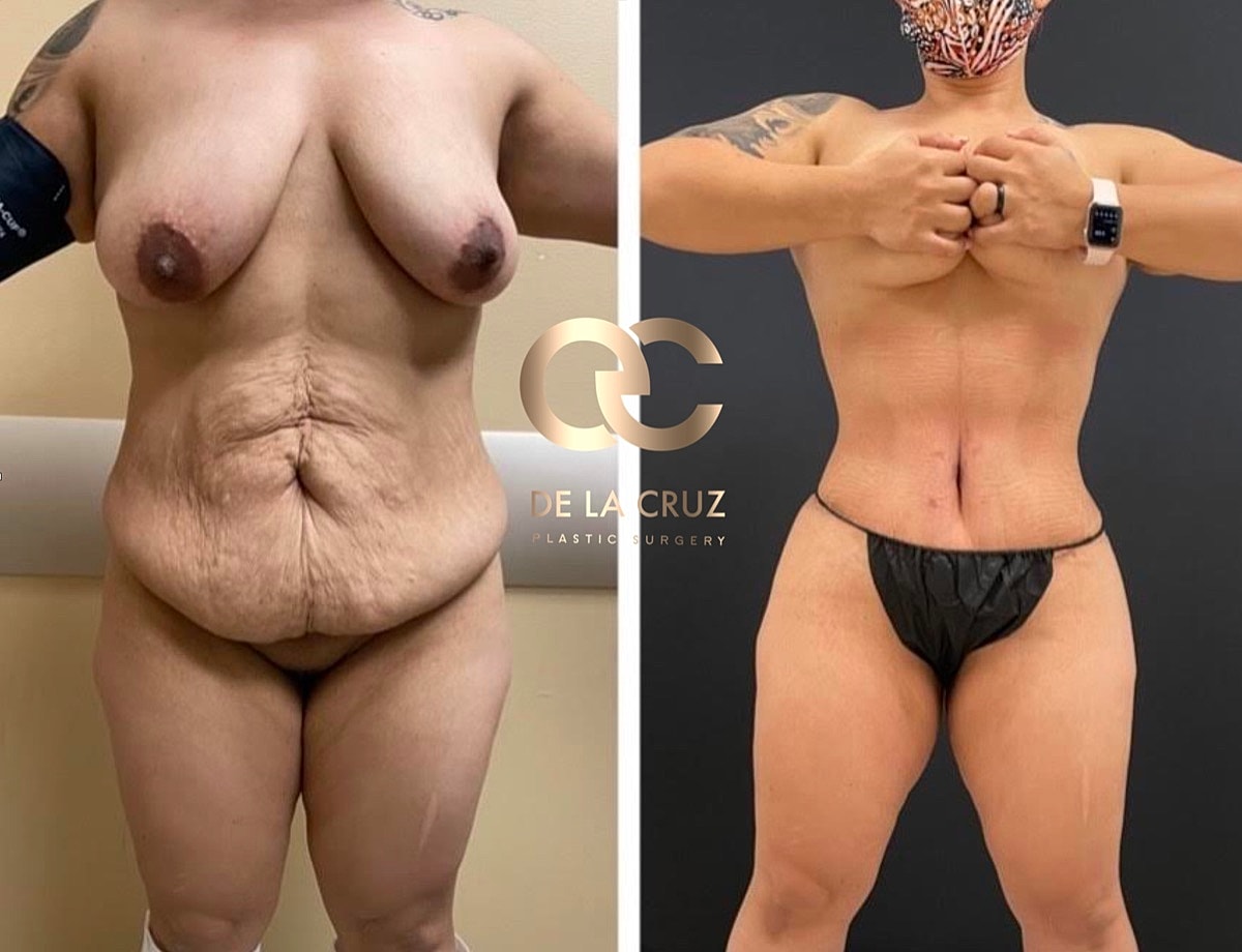 Abdominoplasty Before & After