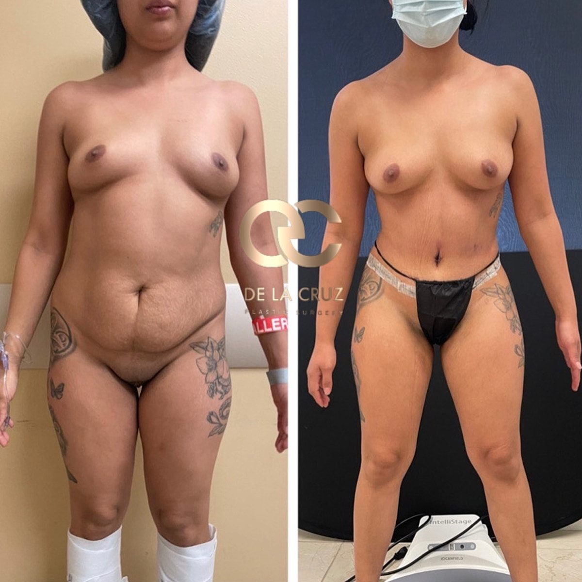 Abdominoplasty Before & After