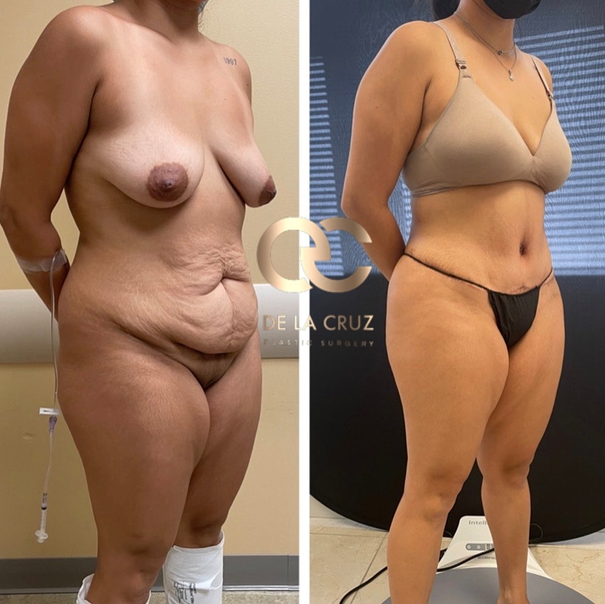 Abdominoplasty Before & After