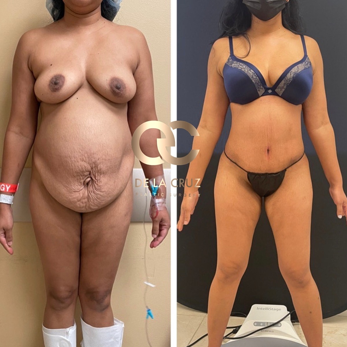 Abdominoplasty Before & After