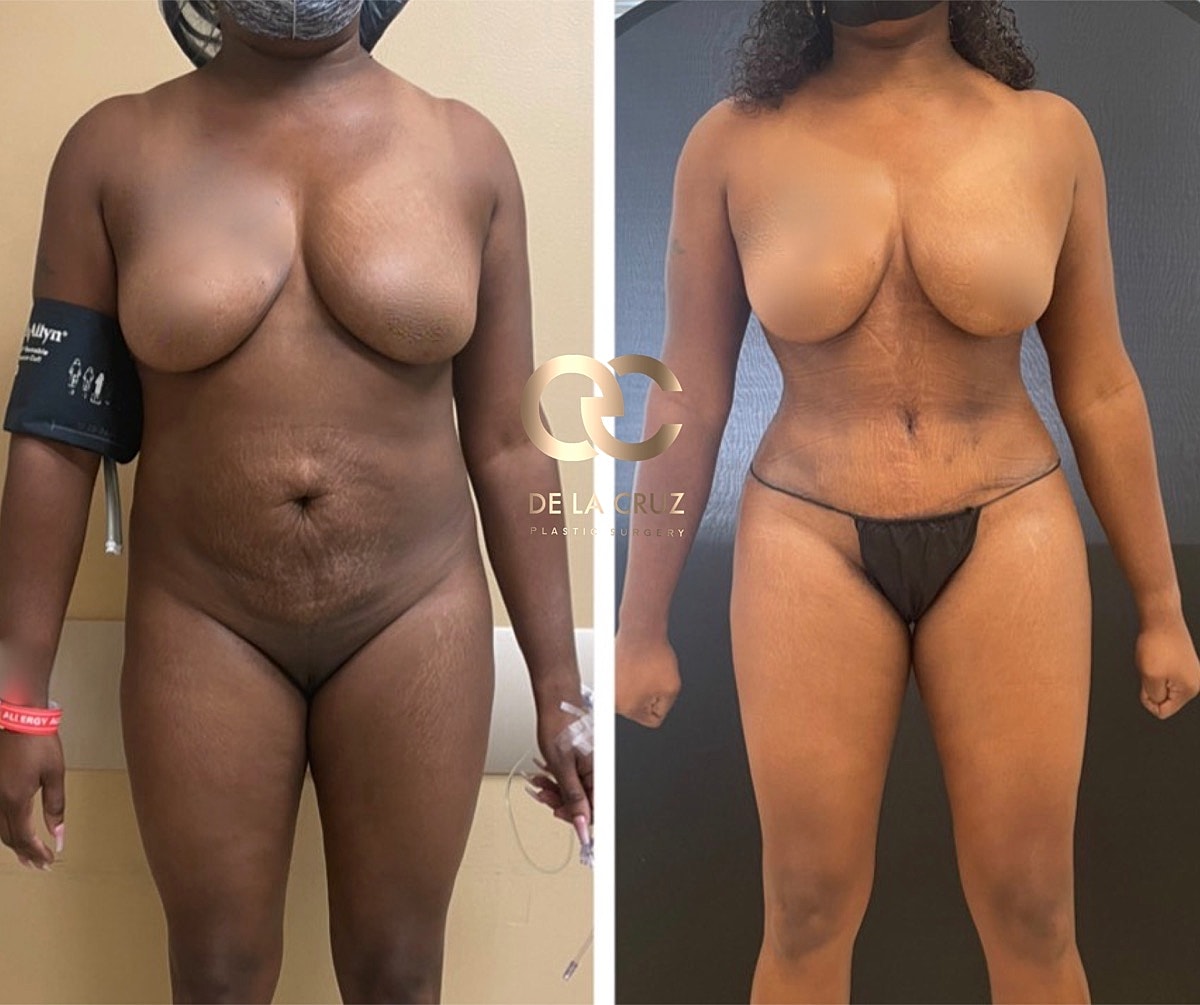 Abdominoplasty Before & After