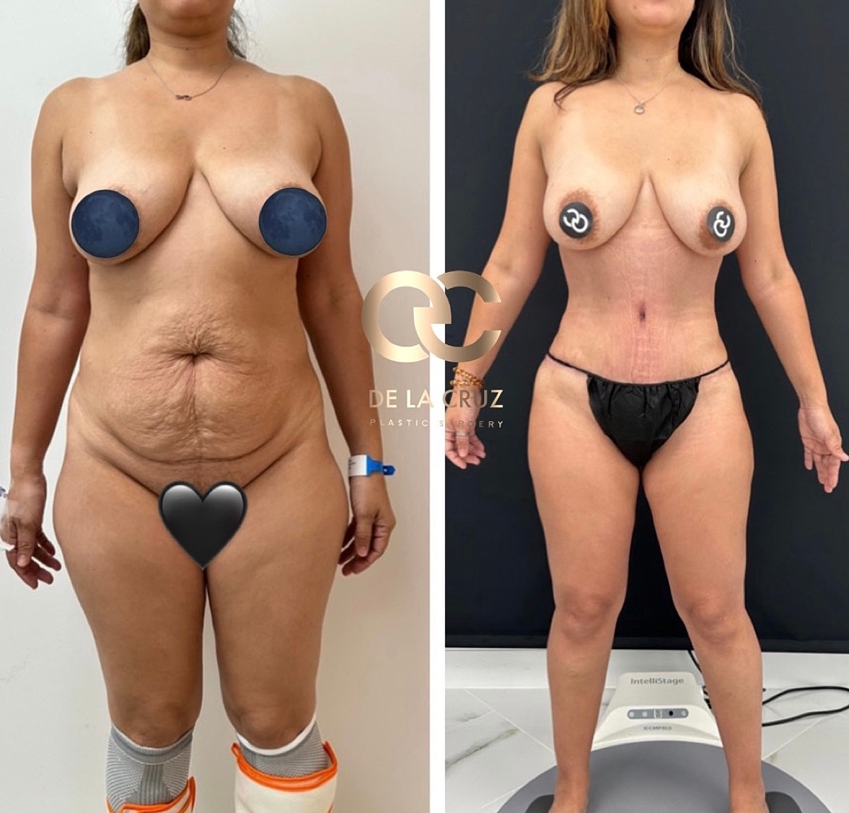 Abdominoplasty Before & After