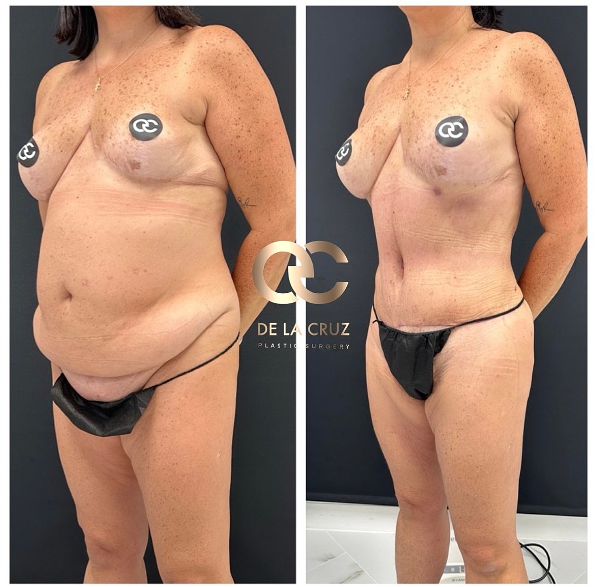 Abdominoplasty Before & After