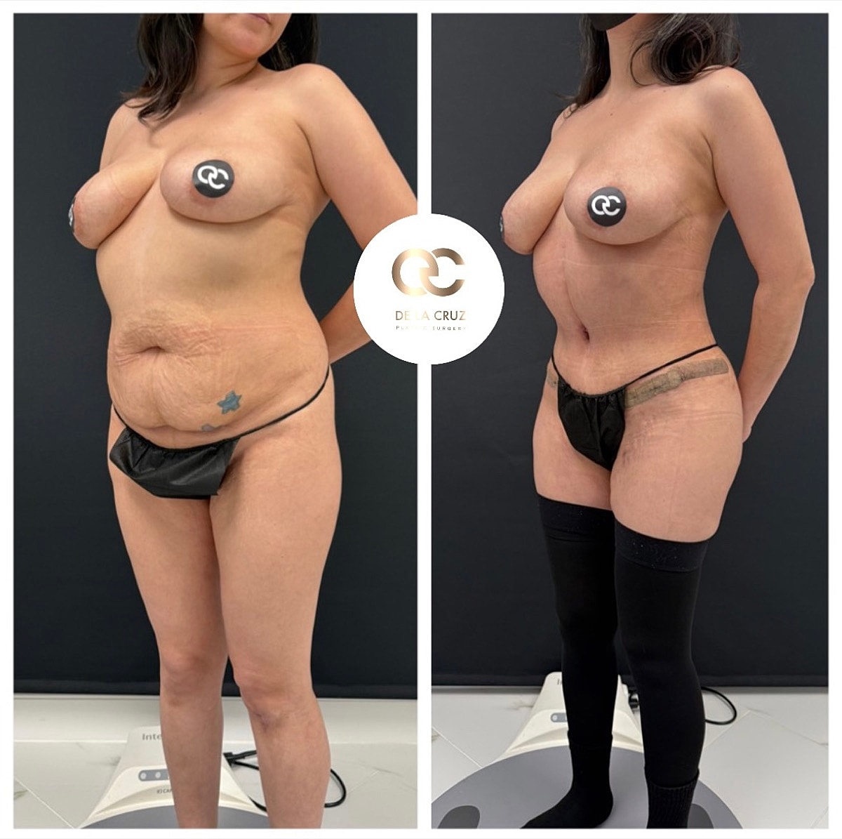 Abdominoplasty Before & After