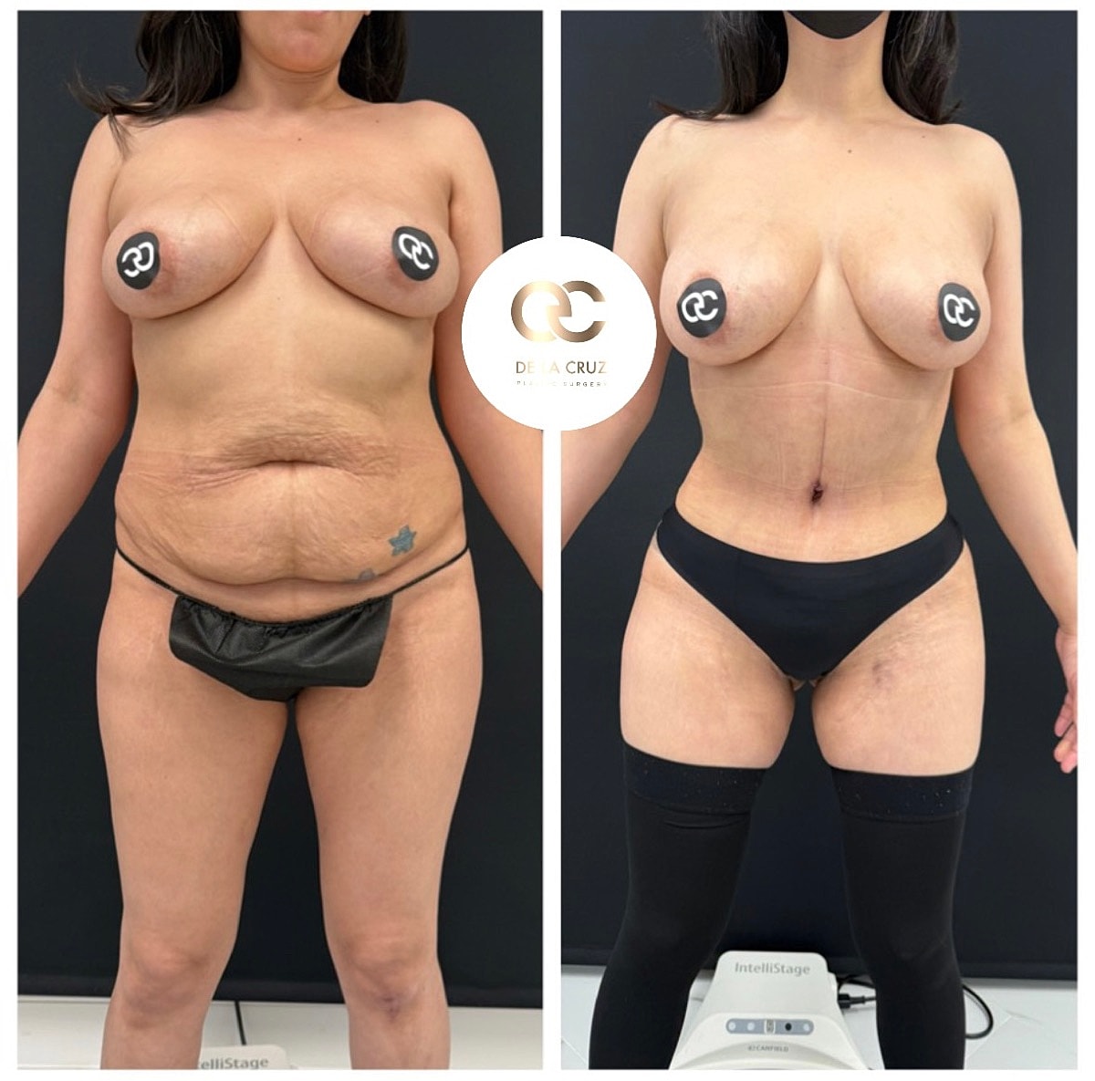 Abdominoplasty Before & After