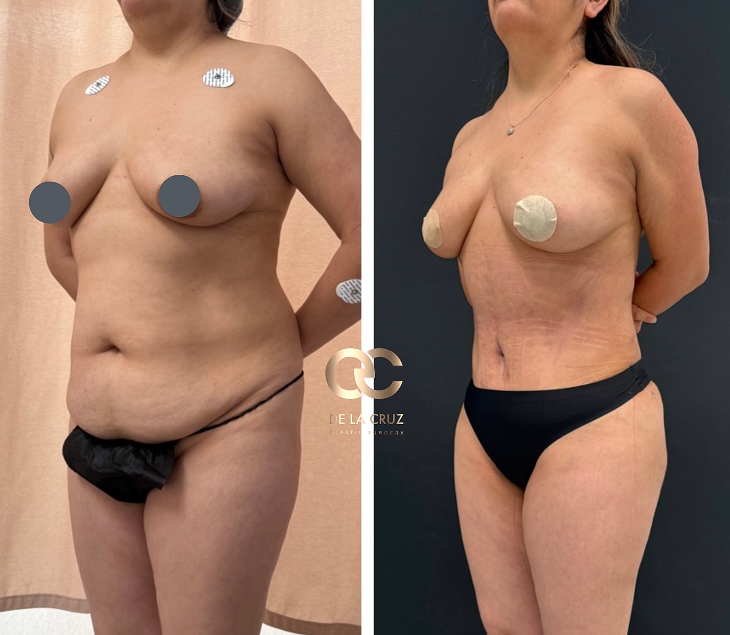 Abdominoplasty Before & After
