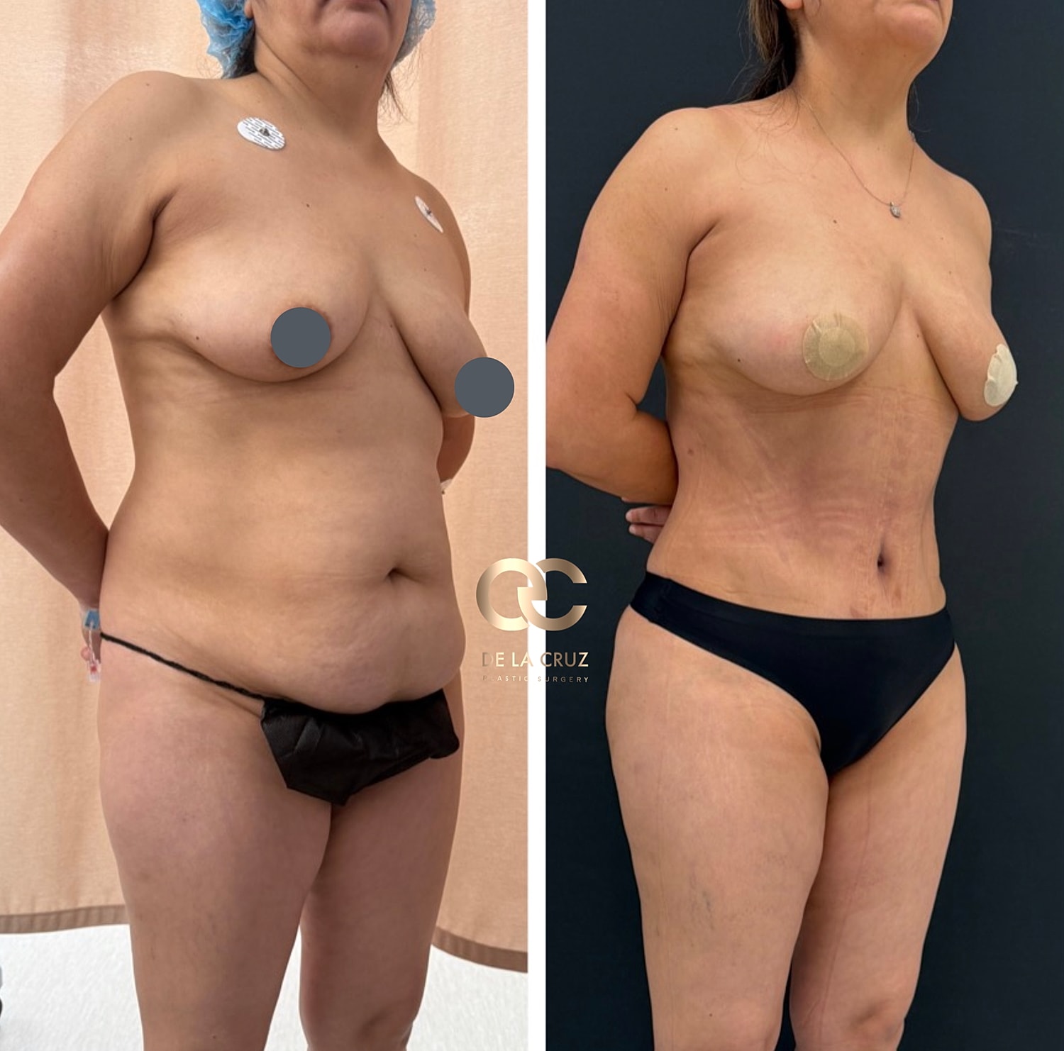 Abdominoplasty Before & After