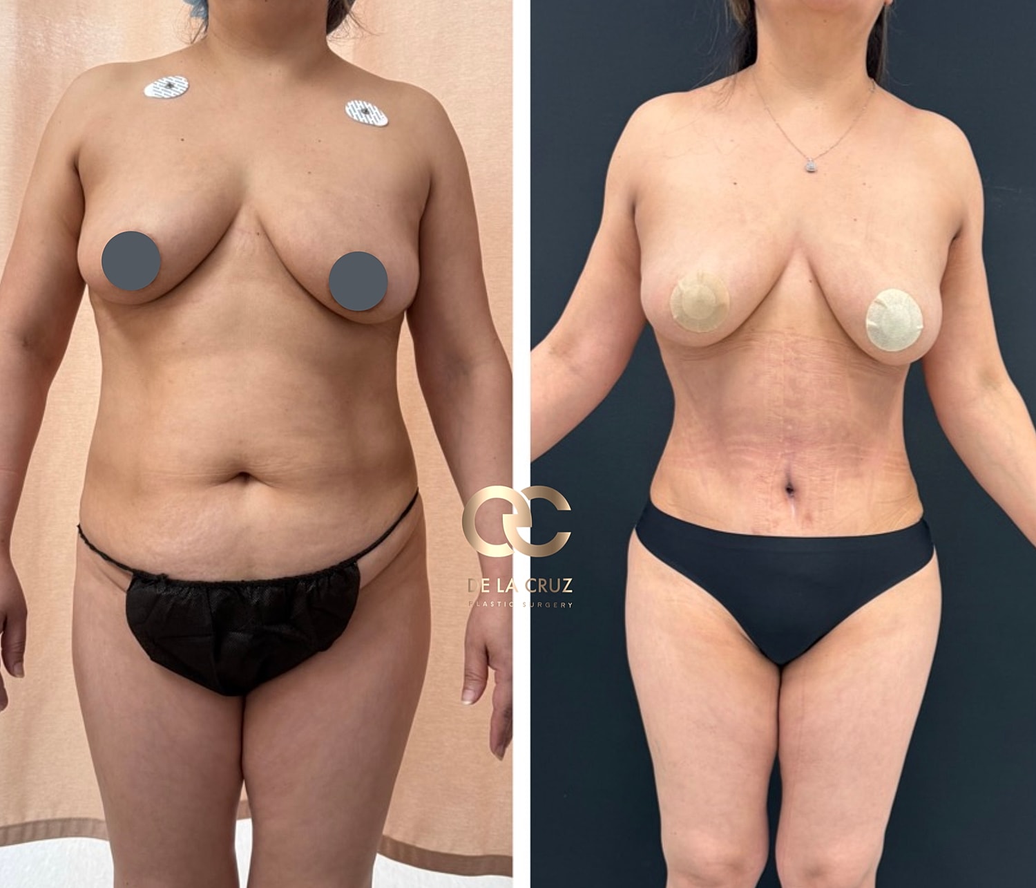 Abdominoplasty Before & After