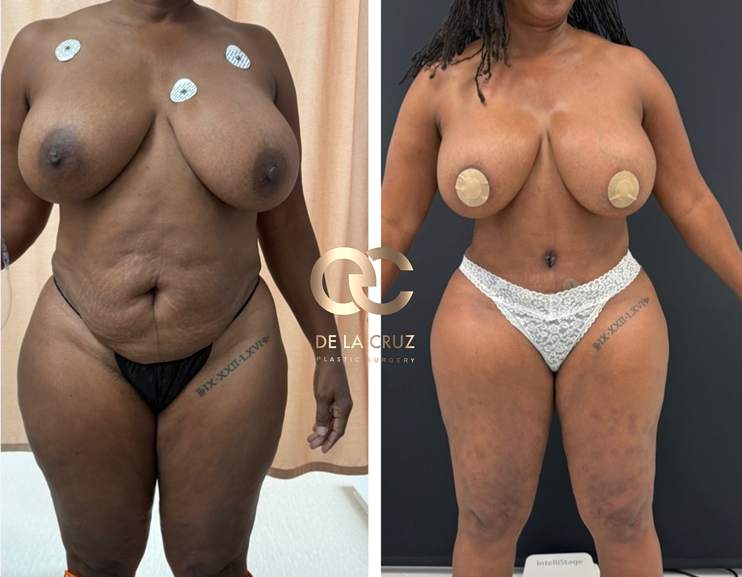 Abdominoplasty Before & After