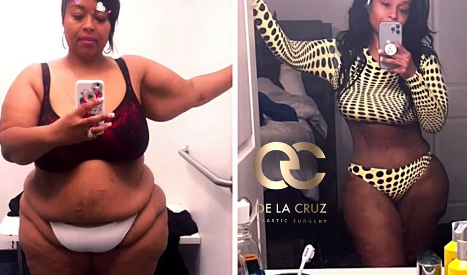 Abdominoplasty Before & After